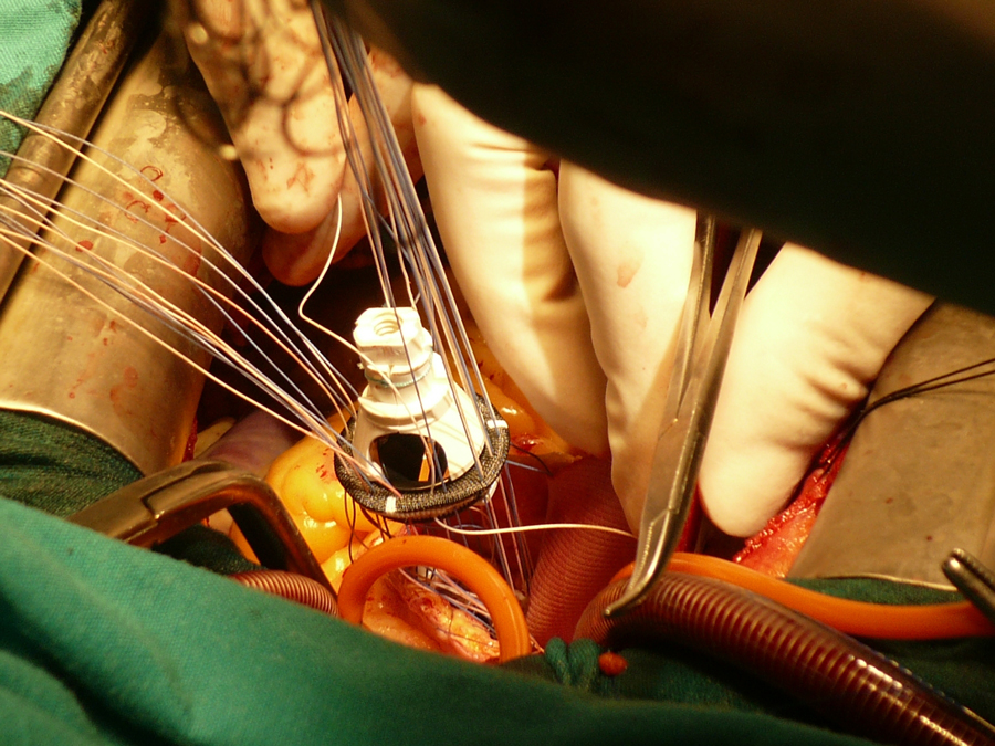 Implante de prótesis cardiovascular aórtica