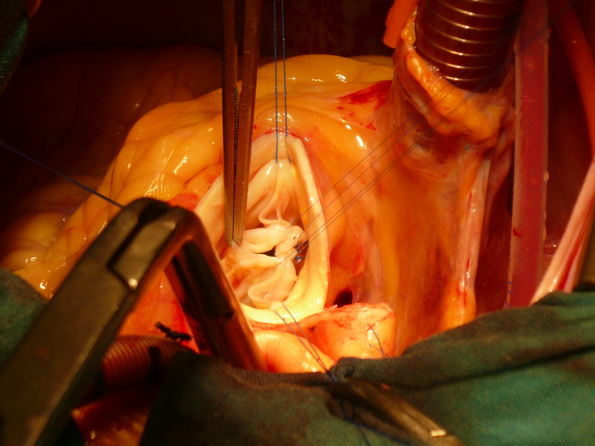 Reparación de válvula aórtica